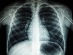 Image radiographique d&#039;un torse humain (Source de l&#039;image : Umanoide via Unsplash ; recadré)