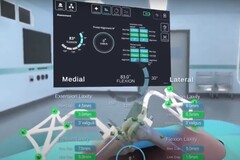 L&#039;interface de STELLAR Knee affichant les dimensions et positions calculées des os de la jambe lors d&#039;une opération du genou. (Source : PolarisAR sur Youtube)