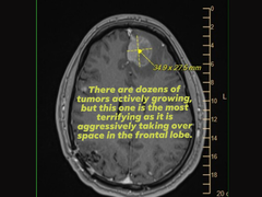 Une image de l'IRM de Michael Prinke, téléchargée par sa femme sur les réseaux sociaux