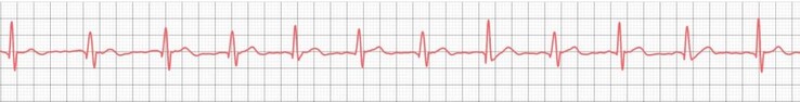 Même les montres connectées bon marché ont démontré qu'elles étaient capables d'enregistrer correctement des ECG de base