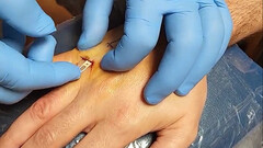 L'implant de clé de voiture Tesla peut être inséré via une petite incision cutanée (image : Brandon Dalaly/Twitter)