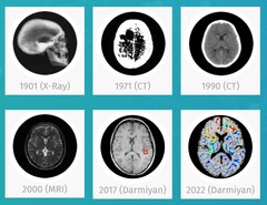 Le logiciel d'IA médicale BrainSee de Darmiyan peut détecter les signes de la maladie d'Alzheimer à un stade précoce. (Source : Darmiyan)
