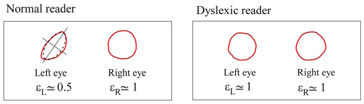 Les centroïdes de Maxwell diffèrent en symétrie chez les sujets normaux, mais sont similaires chez les sujets dyslexiques. (Source de l'image : DOI 10.3390/brainsci13101478) 