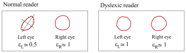 Les centroïdes de Maxwell diffèrent en symétrie chez les sujets normaux, mais sont similaires chez les sujets dyslexiques. (Source de l'image : DOI 10.3390/brainsci13101478) 