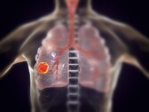 Rien qu'en 2022, 131 888 personnes sont décédées d'un cancer du poumon aux États-Unis. (Source de l'image : KATERYNA KON/SCIENCE PHOTO LIBRARY/Getty Images)