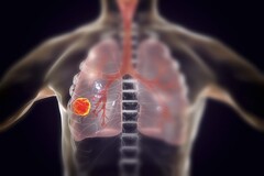 Rien qu&#039;en 2022, 131 888 personnes sont décédées d&#039;un cancer du poumon aux États-Unis. (Source de l&#039;image : KATERYNA KON/SCIENCE PHOTO LIBRARY/Getty Images)