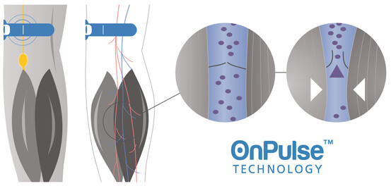 OnPulse (Image source : Sky Medical)